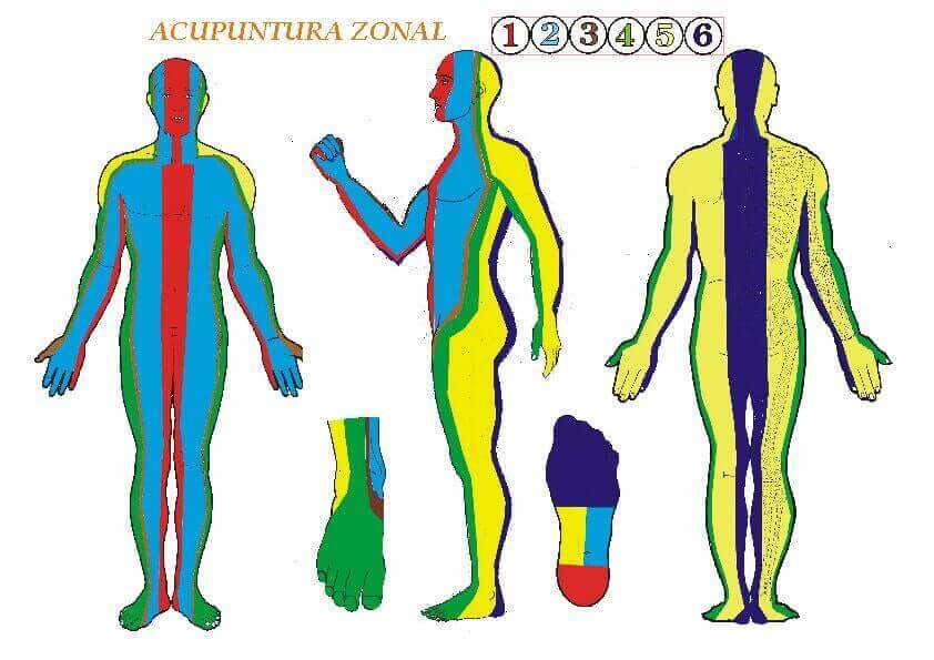 Acupuntura-zonal