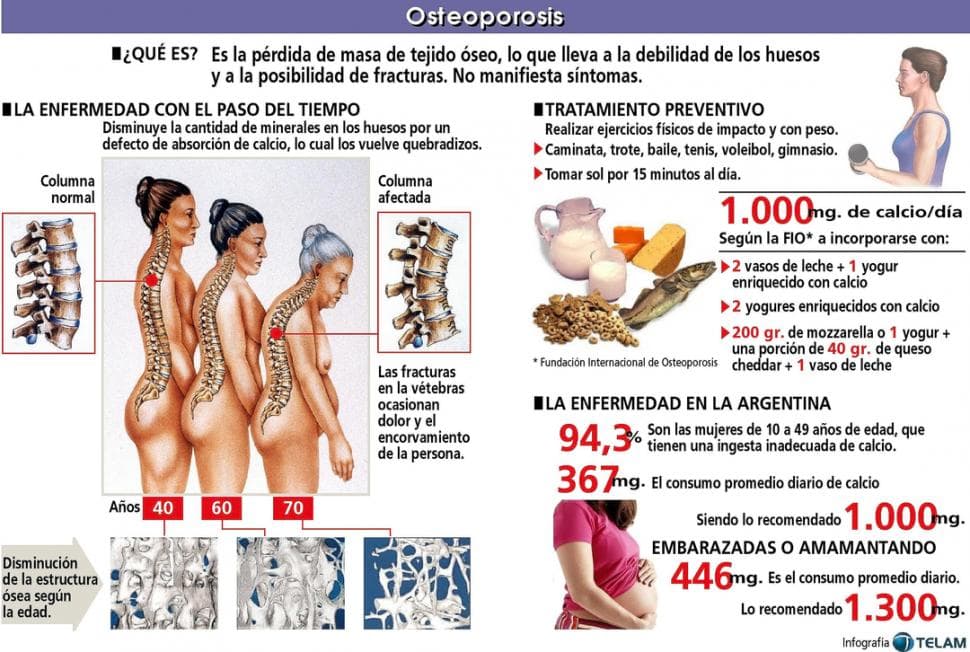 Origen-osteoporosis