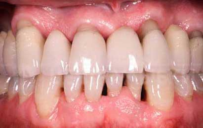 acupuntura-y-periodontitis