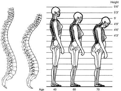 cambios-osteoporosis