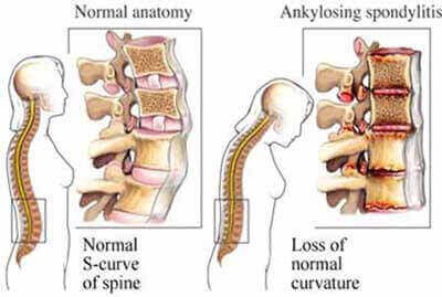 espondilitis