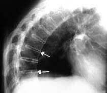 espondiloartrititis