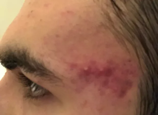 ACNE en la sién