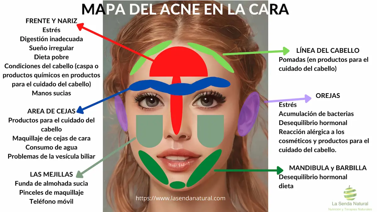 MAPA DEL ACNE EN LA CARA