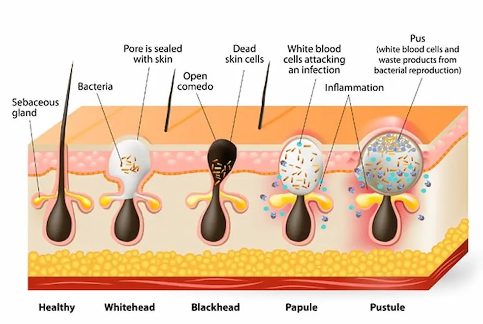 Tipos de acné