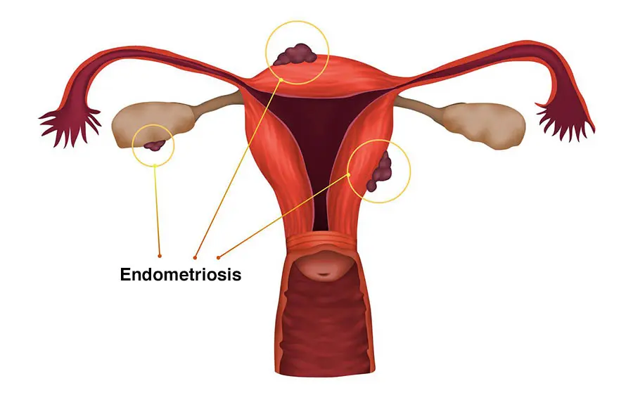 endometriosis