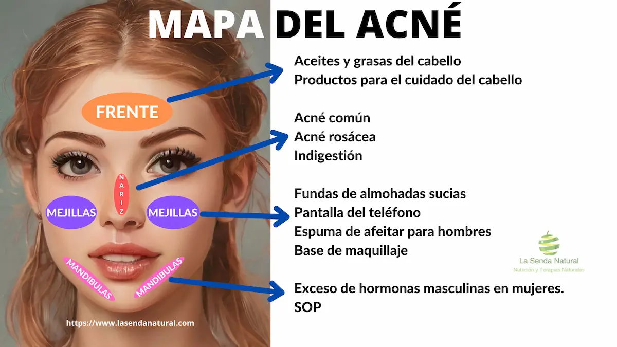 mapeo del acné