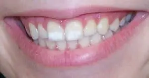 manchas-blancas en los dientes