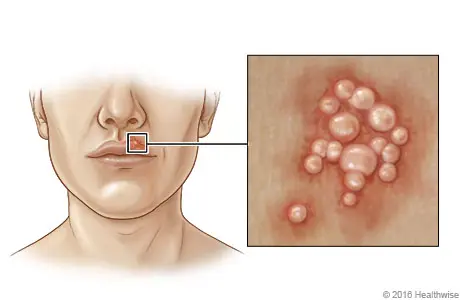 Herpes virus 1