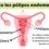 Pólipos vaginales