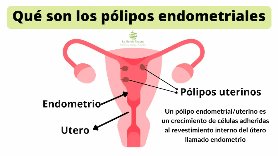 Que son los pólipos vaginales